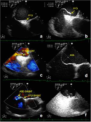 A Prospective, Single-Center, Phase I Clinical Trial to Evaluate the Value of Transesophageal Echocardiography in the Closure of Patent Foramen Ovale With a Novel Biodegradable Occluder